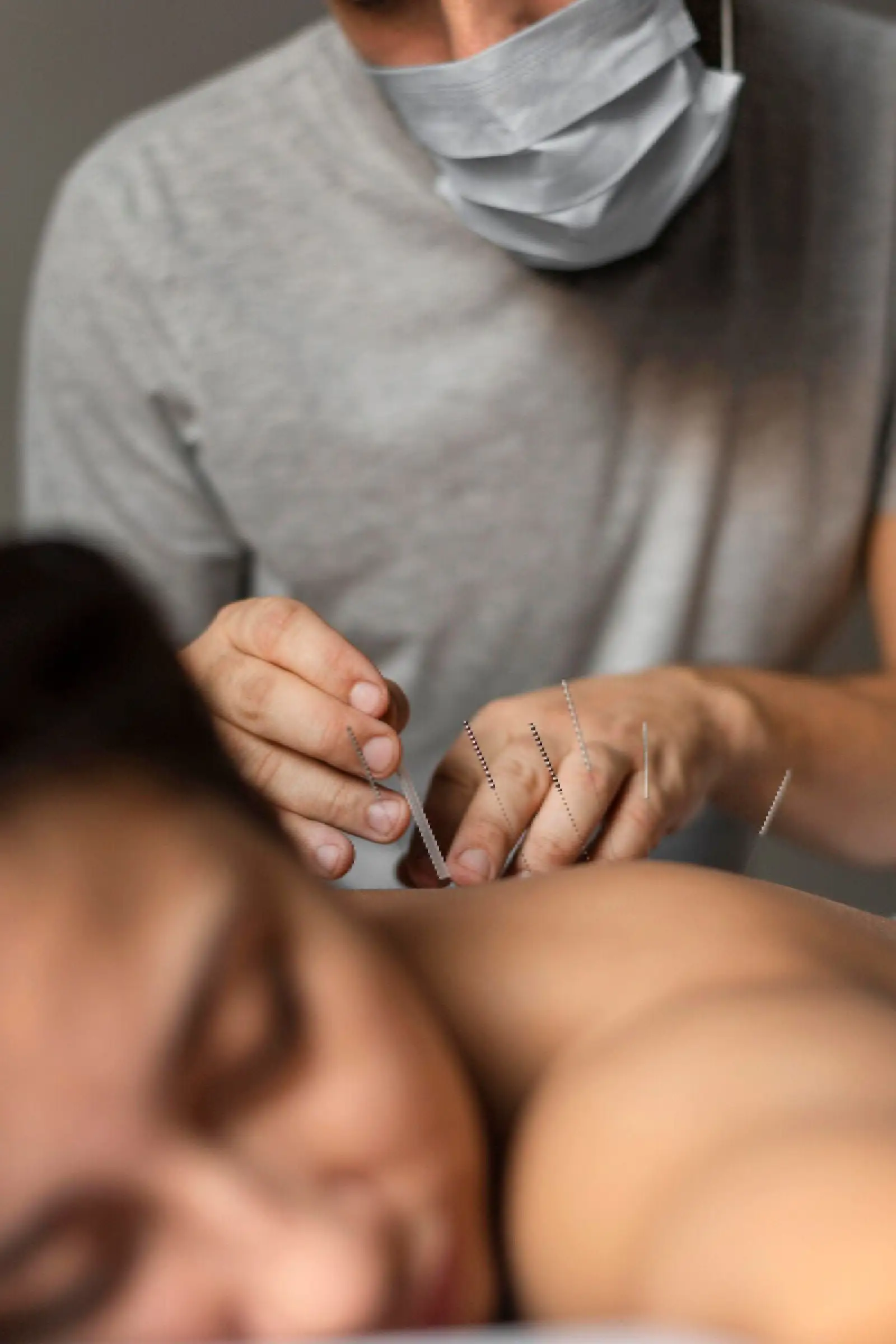 acupencture pratique acupencture pratique