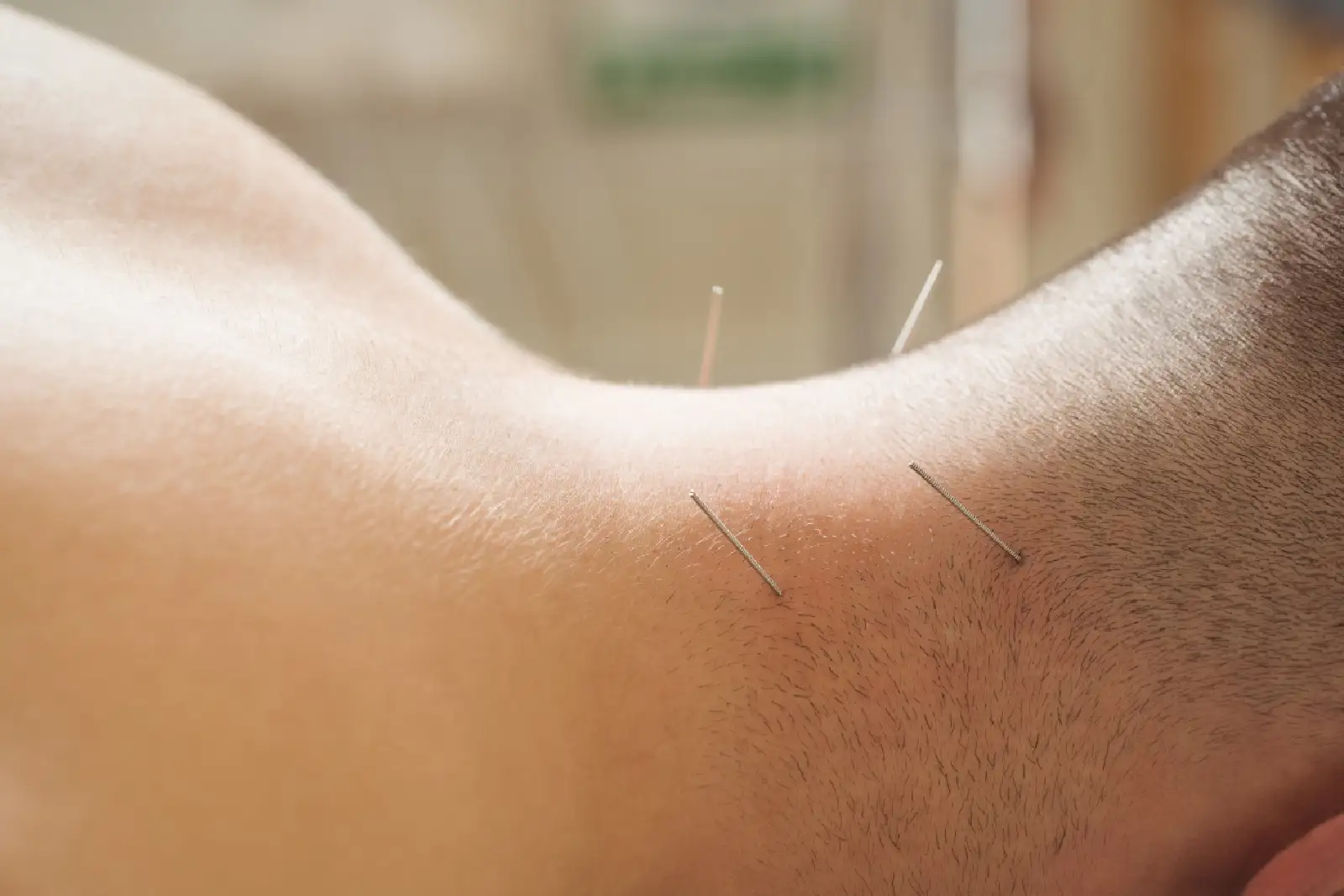 acupencture sur le cou acupencture sur le cou