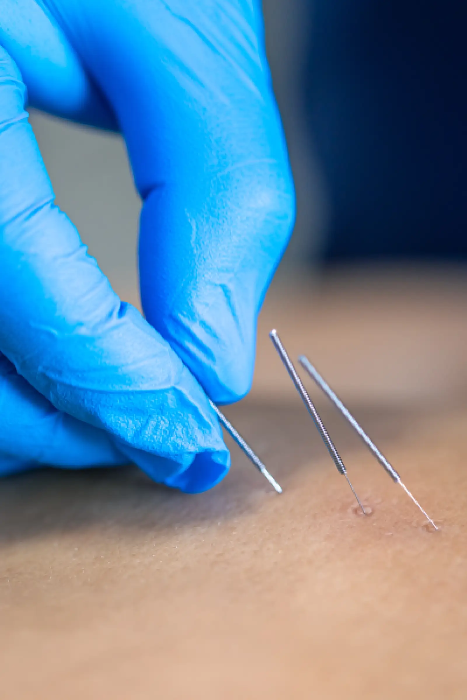 technique acupencture technique acupencture